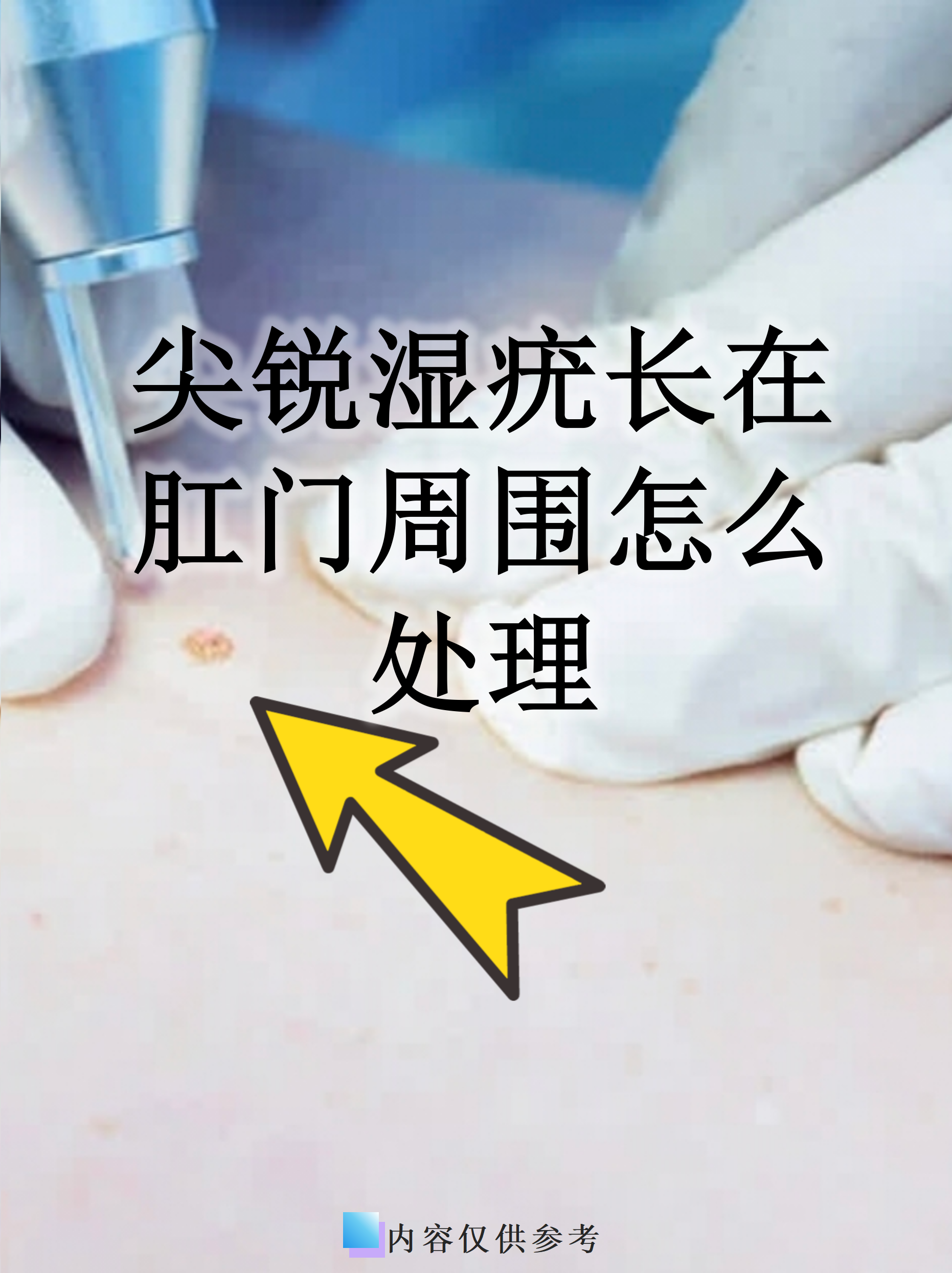 尖锐湿疣怎么治疗才能根治好治吗_(尖锐湿疣治疗最佳办法) 第1张 尖锐湿疣怎么治疗才能根治好治吗_(尖锐湿疣治疗最佳办法) 第1张